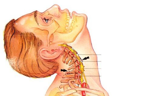 how is osteochondrosis of the cervical spine