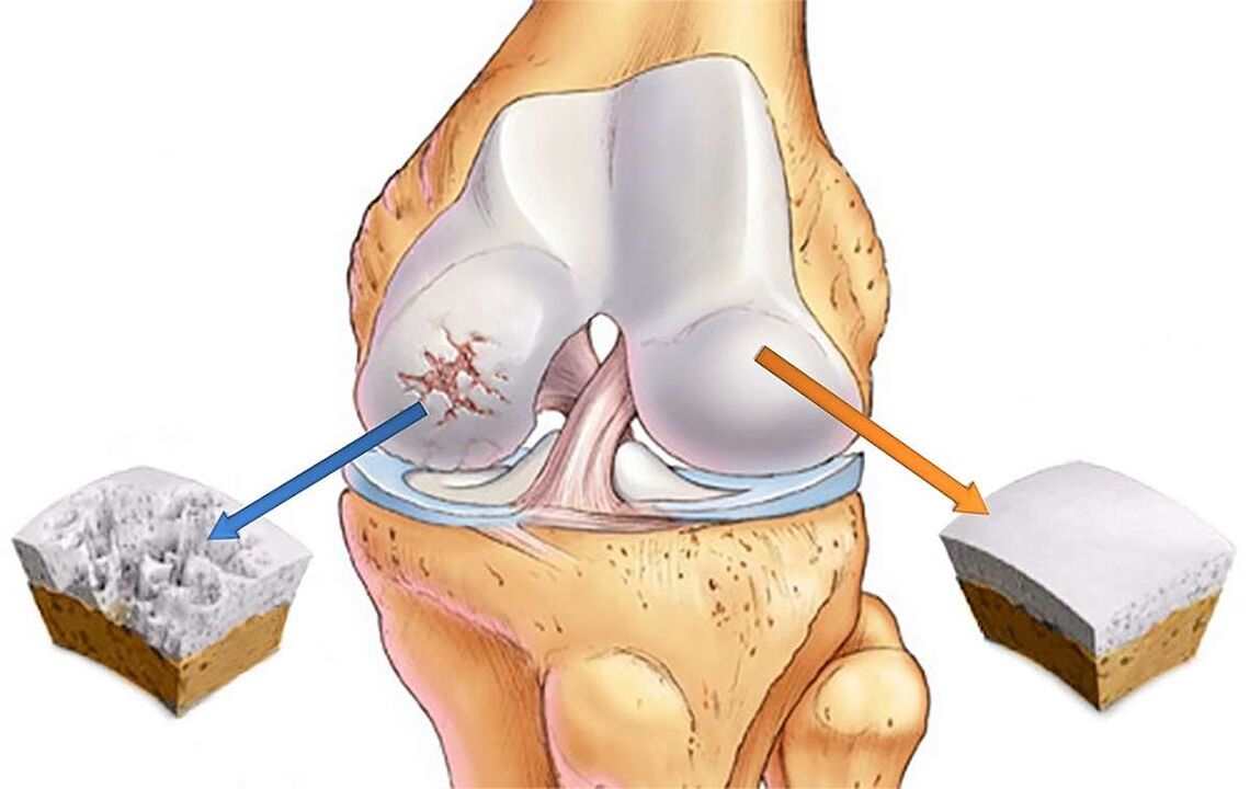 Knee joint cartilage destruction with gonarthrosis
