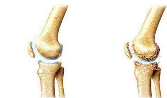 Atrocise symptoms based on the knee