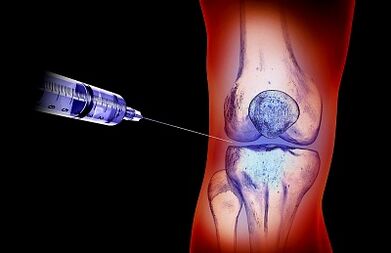 The Knee Articulation Arthrosis Treatment Plan