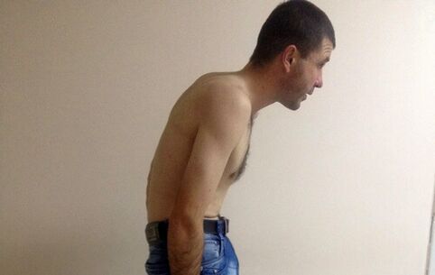 Ankylosing spondylitis can cause low back pain over the years
