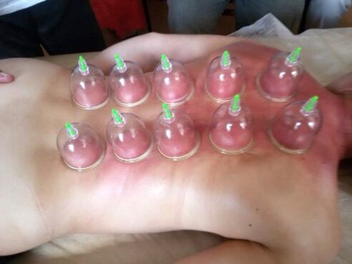 Vacuum cupping is an excellent way to treat lower back pain at home