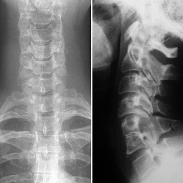 Cervical spine x-ray